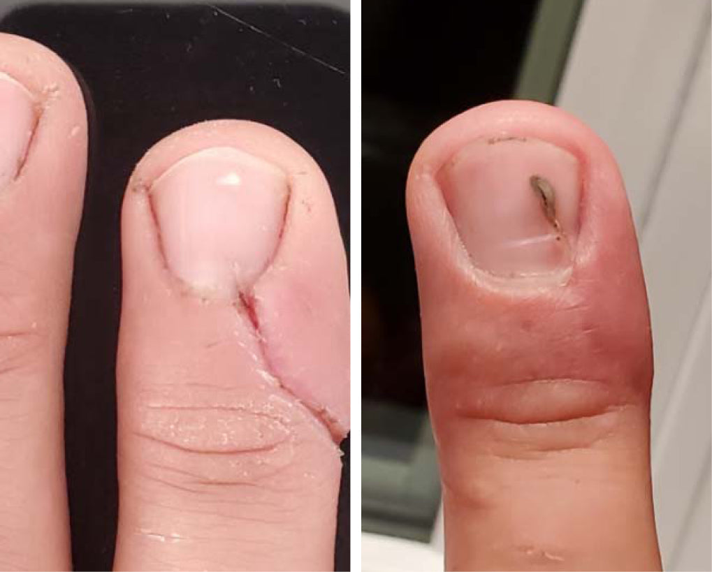 comment cicatriser une plaie infectée