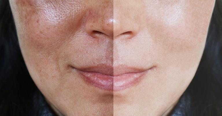 Comment réduire les taches brunes sur le visage OLD