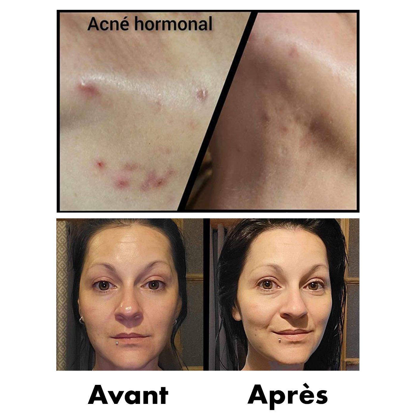Avant-Apres Acne