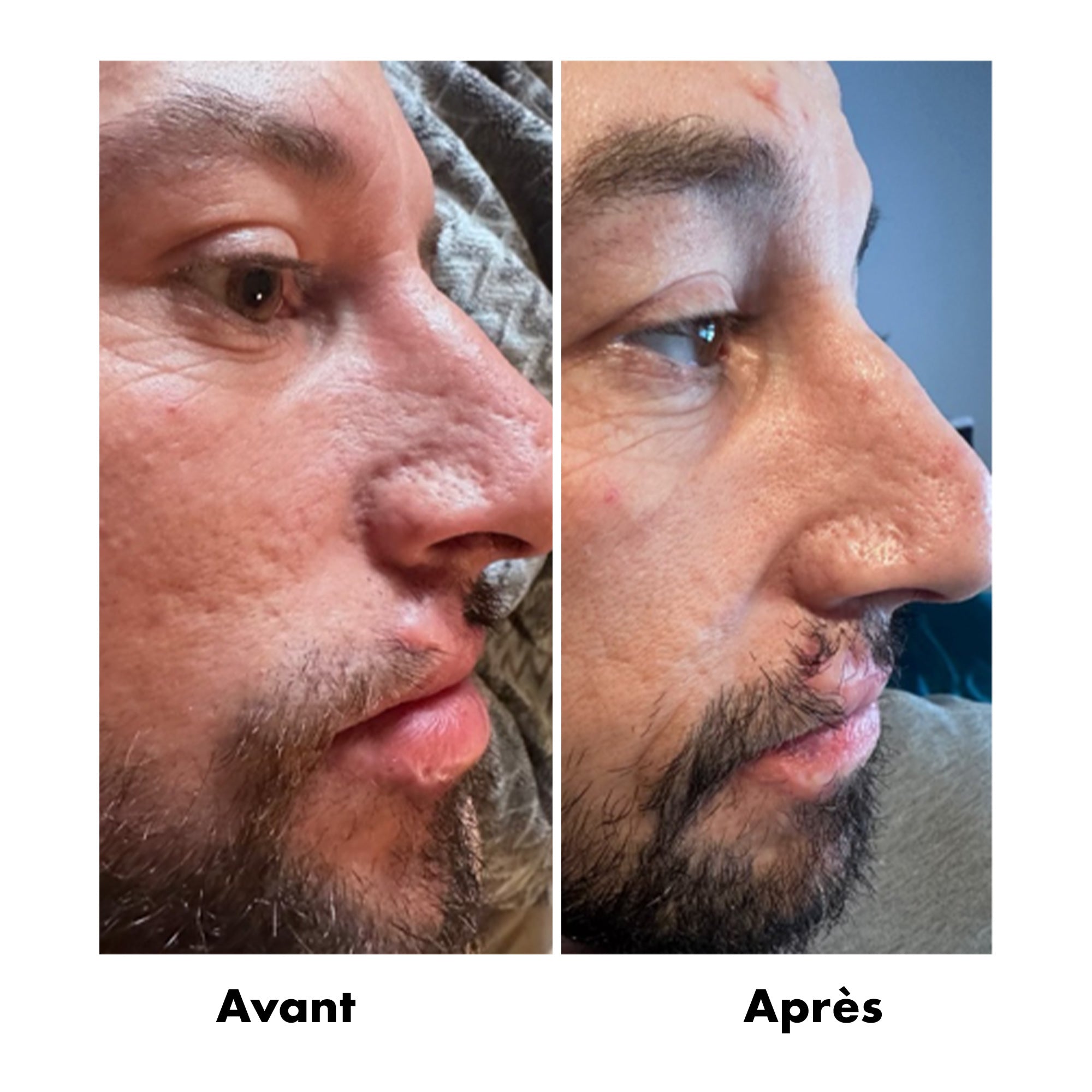 Avant-Apres Acne 2
