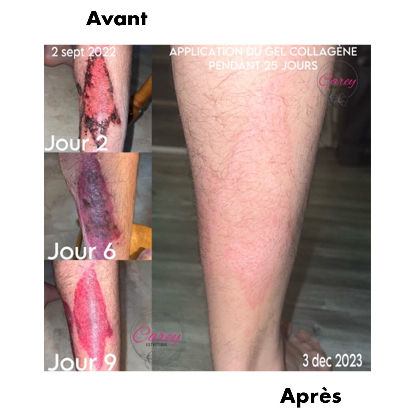 Avant-Apres Brulure
