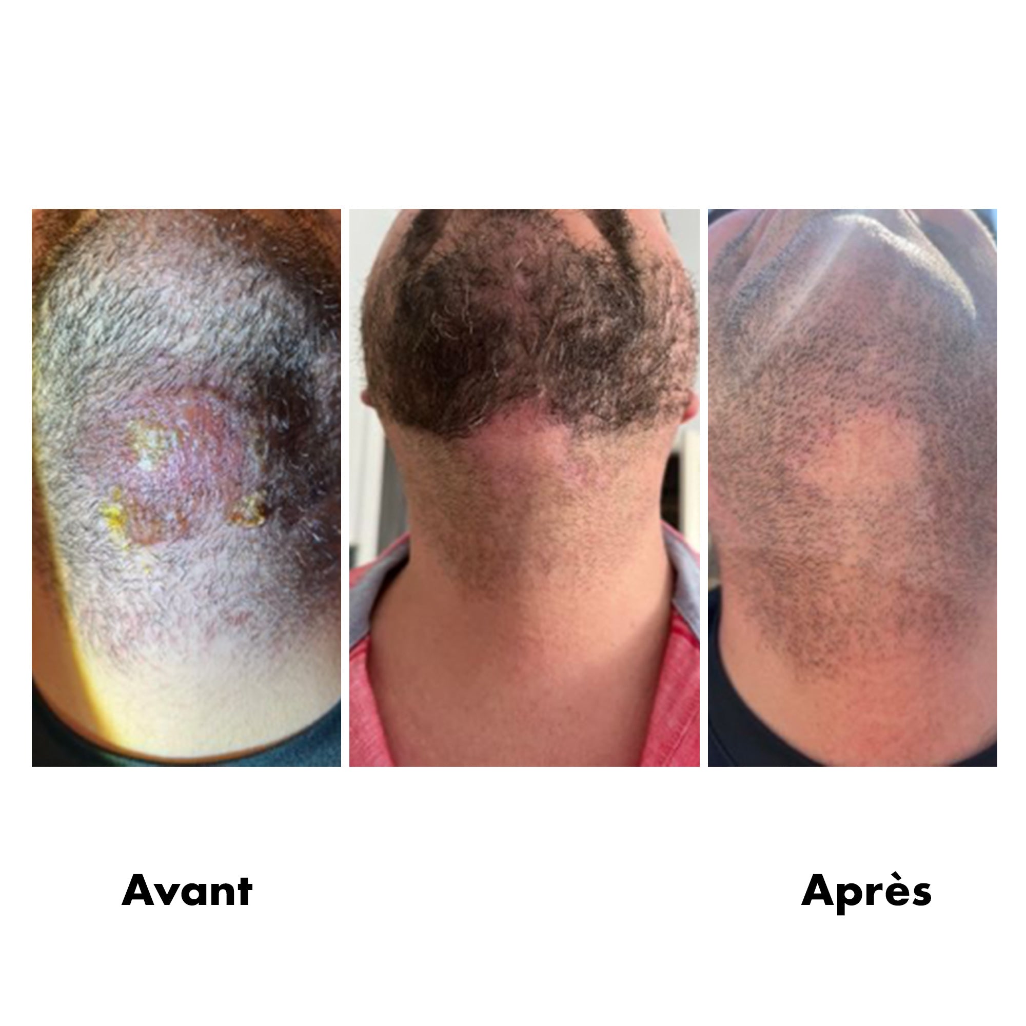 Avant-Apres Brulure 2