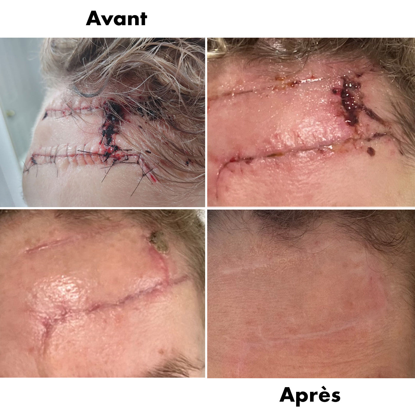 Avant-Apres Cicatrice