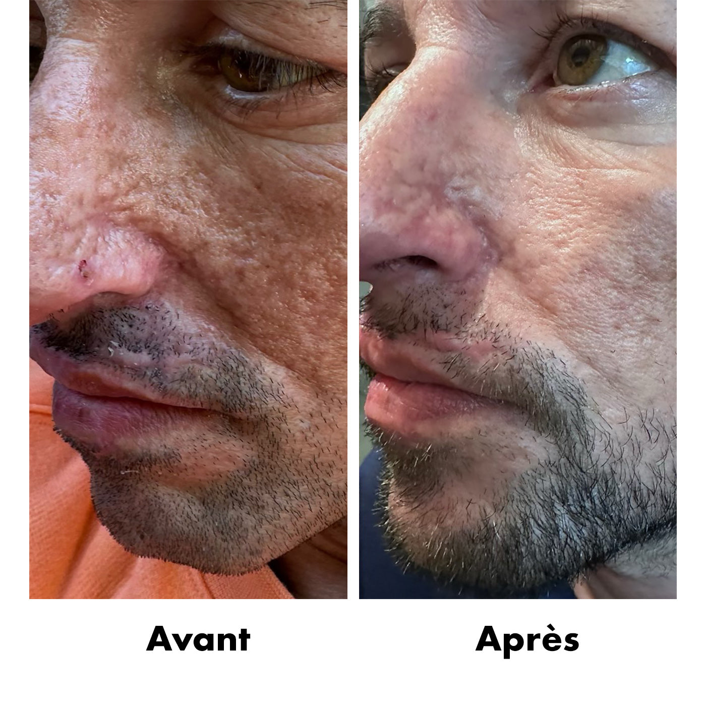 Avant-Apres Cicatrice 2