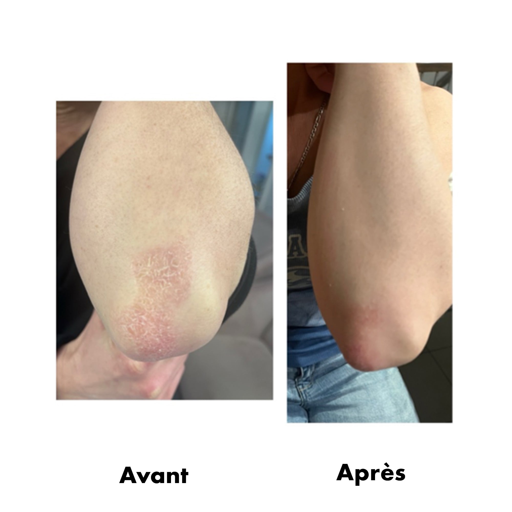 Avant-Apres Eczema 2