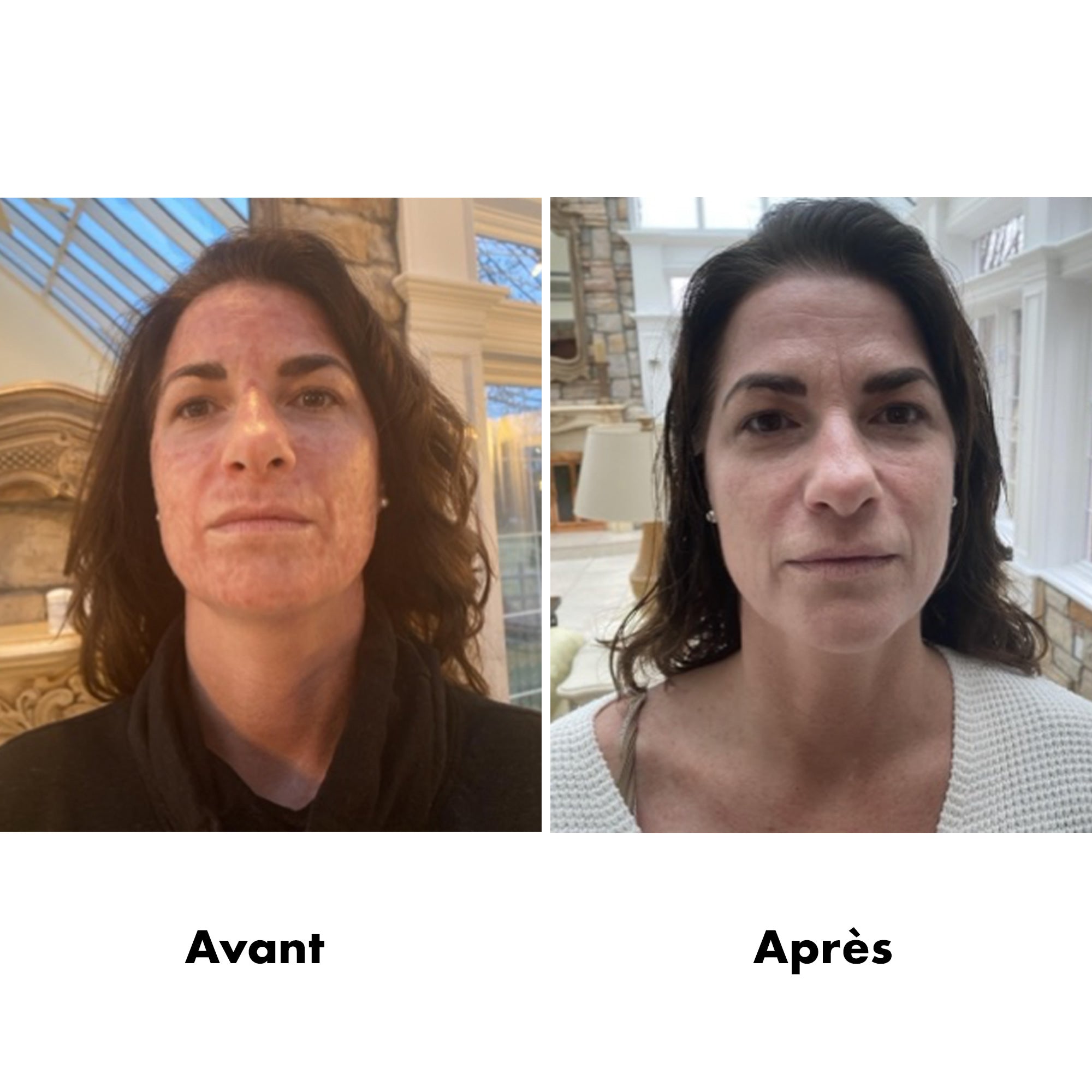 Avant-Apres Laser