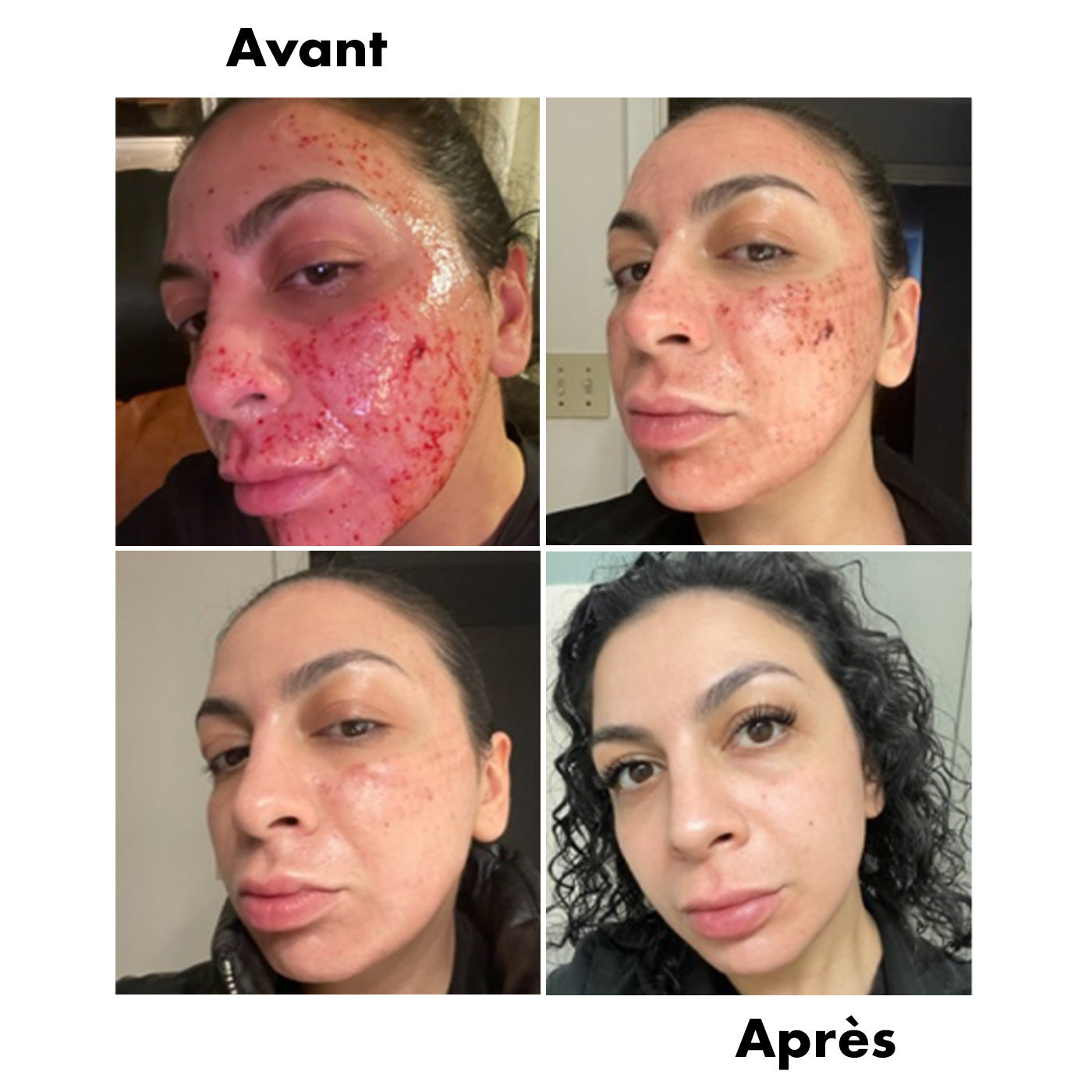 Avant-Apres Laser 2