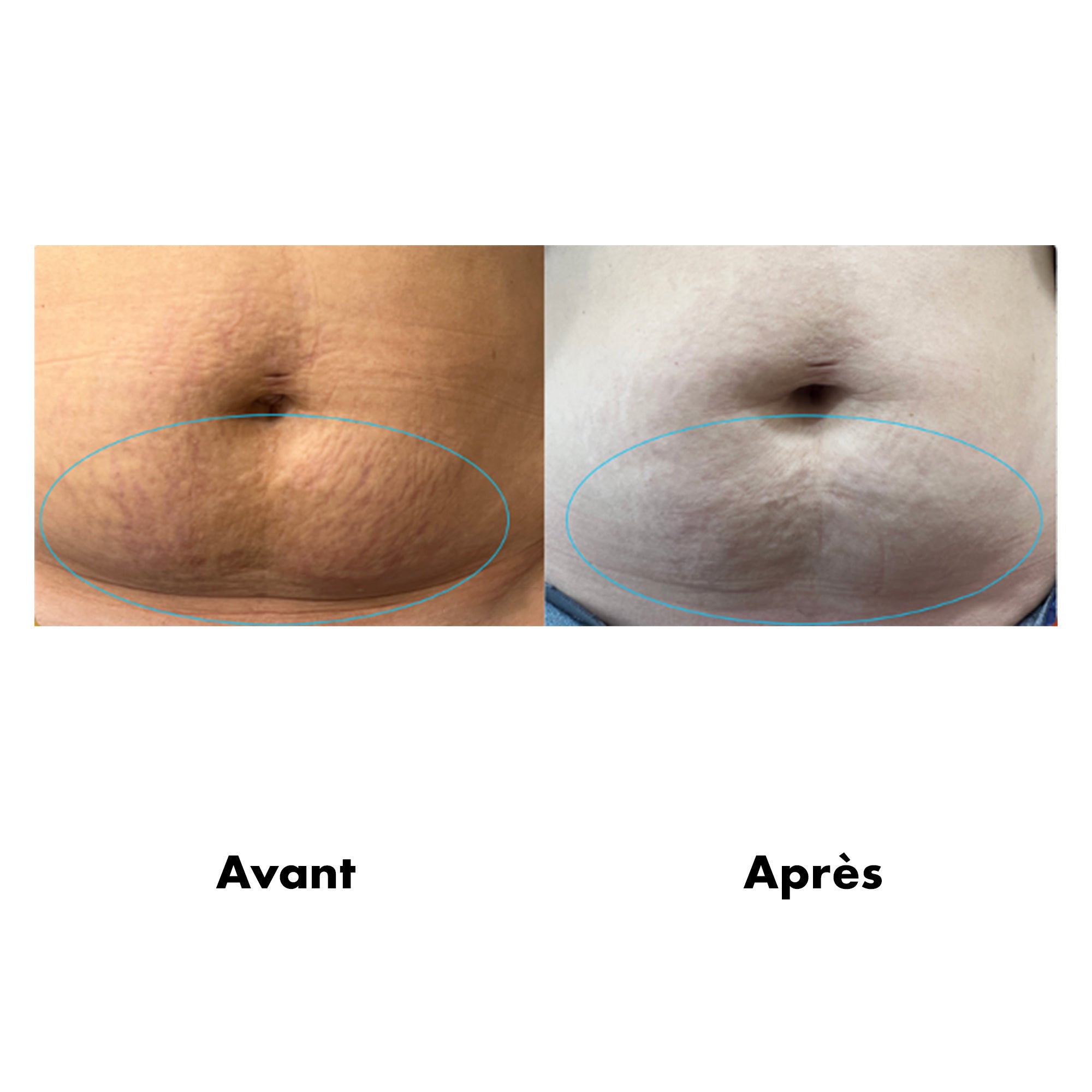 Avant-Apres vergetures
