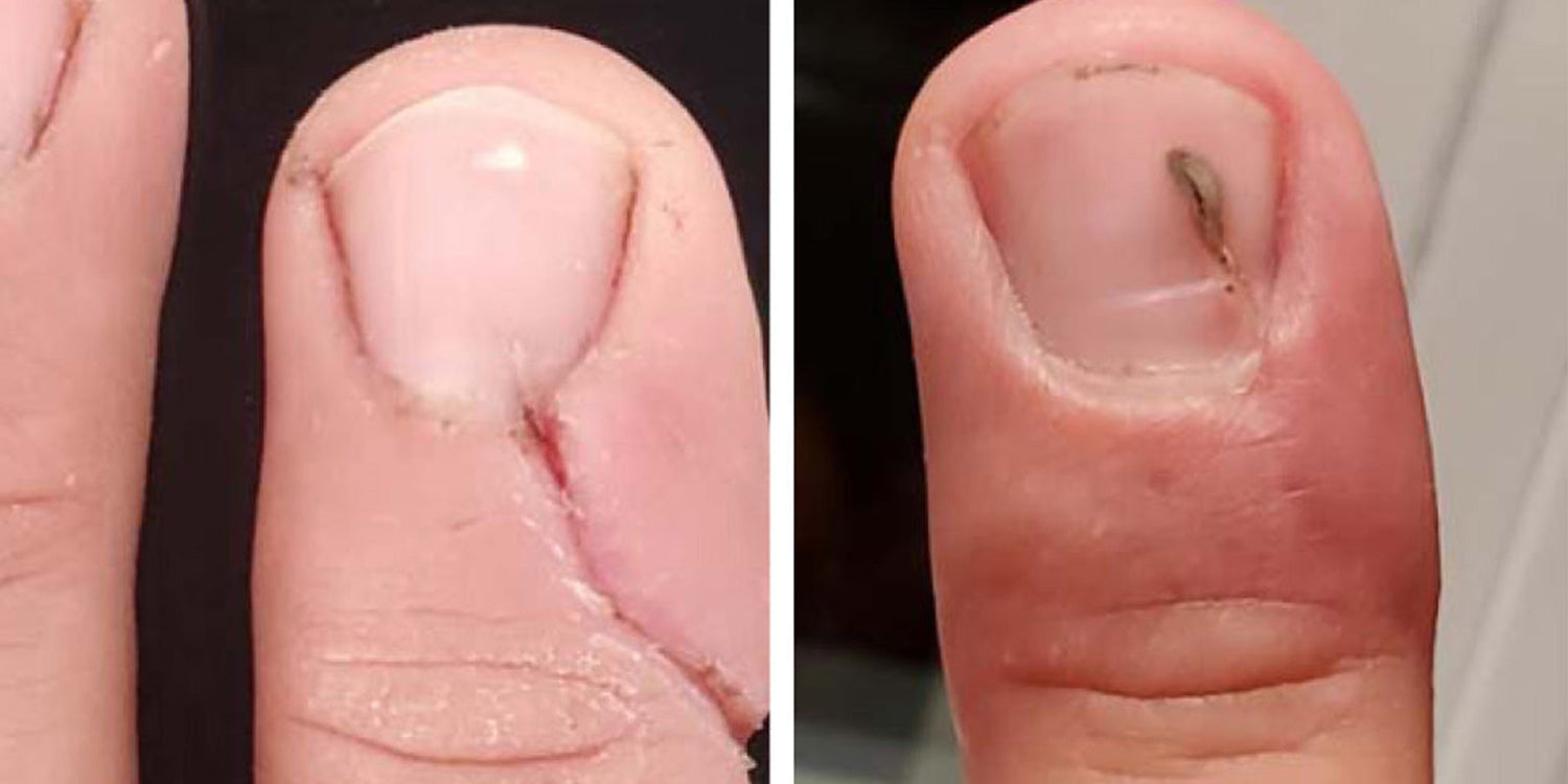 Comment cicatriser une plaie profonde